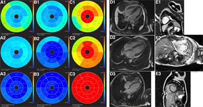 Layer-specific strain in patients with cardiac amyloidosis using tissue tracking MR